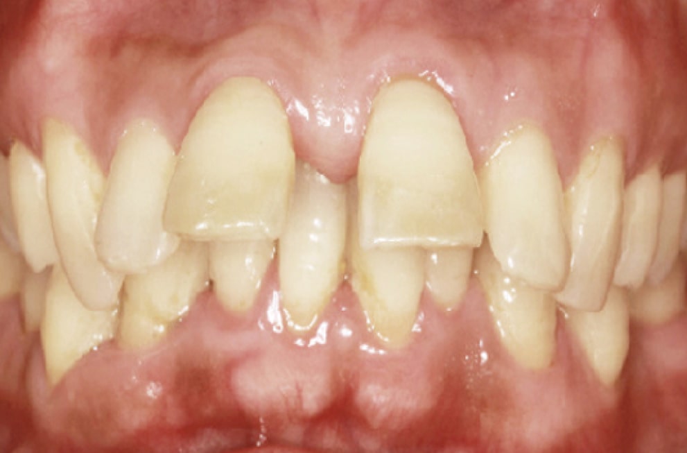 A close-up of human teeth showing severe misalignment, crowding, and overlapping, with uneven spacing and yellow discoloration. The gums appear healthy but are visible due to the irregular teeth arrangement.