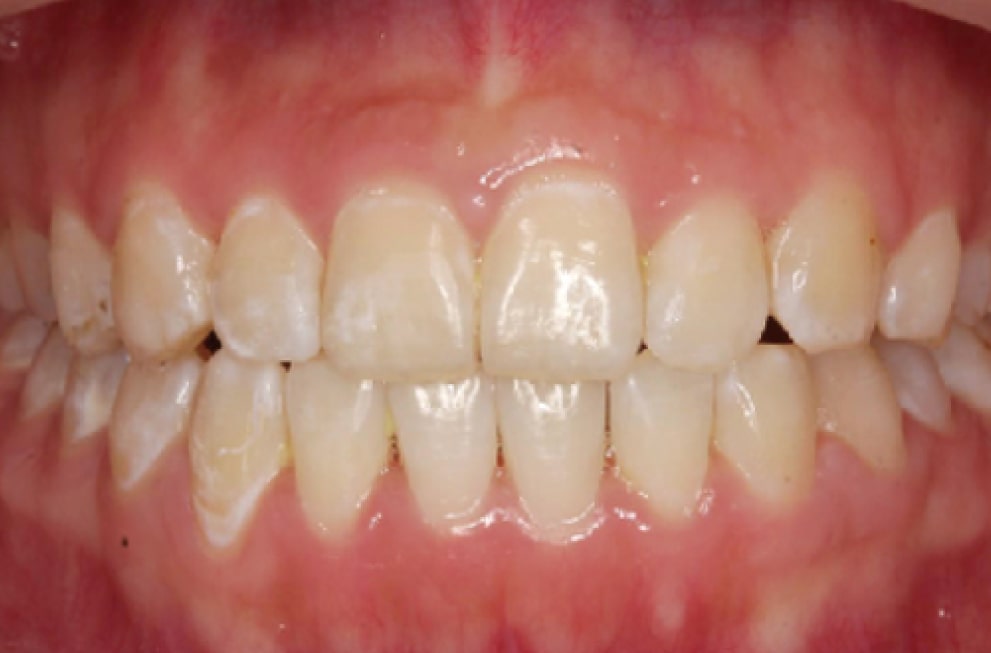 Close-up of a persons mouth showing their upper and lower teeth with some yellowing and plaque buildup. The gums appear pink and slightly inflamed. The teeth are generally aligned but have minor imperfections.