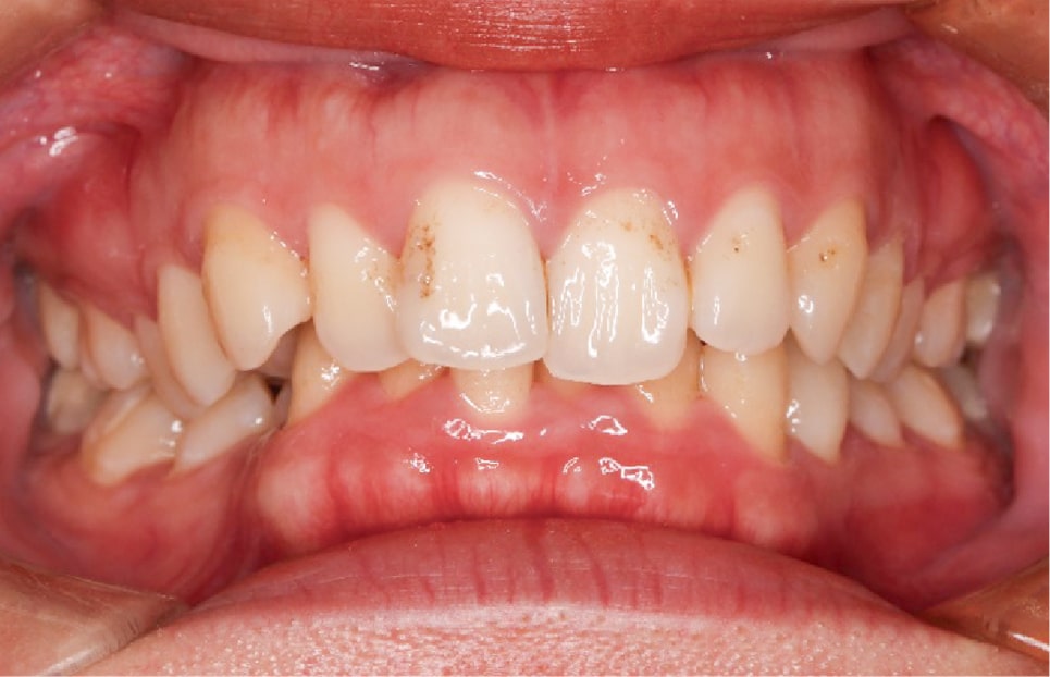 Close-up of a persons mouth showing upper and lower teeth with plaque buildup, mild crowding, and visible gums. The lips are parted to clearly display the dental and gum condition.