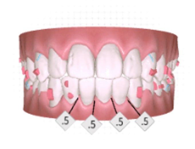 Digital illustration of upper and lower teeth showing dental attachments and spaces between lower front teeth, each marked with a label indicating .5 likely referring to millimeter measurements for dental work.