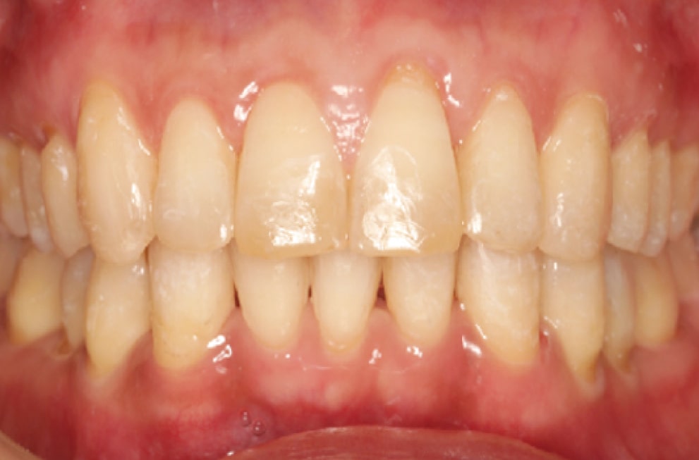 Close-up of human teeth and gums showing the upper and lower front teeth with healthy pink gums, slight enamel wear visible on some teeth.