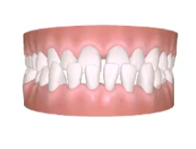 A digital illustration of human teeth showing an open bite, where the upper and lower front teeth do not touch when the mouth is closed. The gums and teeth are clearly visible.