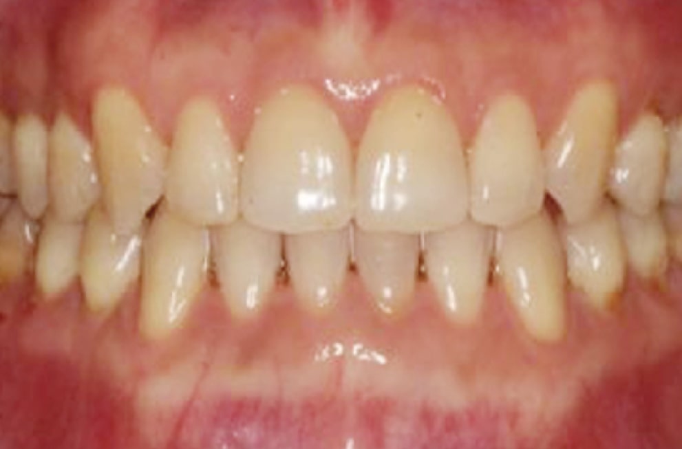 Close-up of a persons teeth with visible gum line. The teeth appear slightly misaligned, with some discoloration and plaque buildup near the gums. The mouth is open, showing both upper and lower teeth.