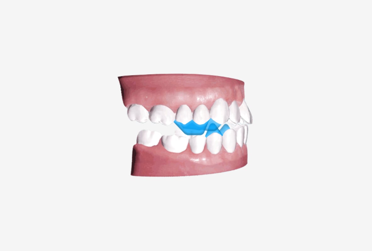 photo of Mandibular Advancement Solution