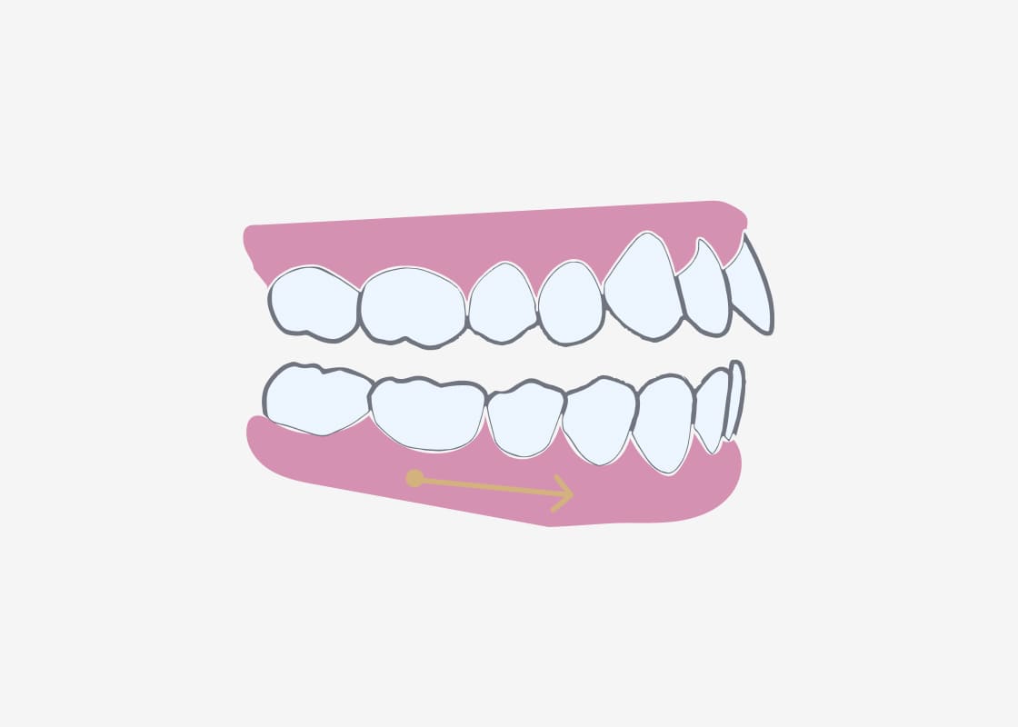 photo of Bite Opening