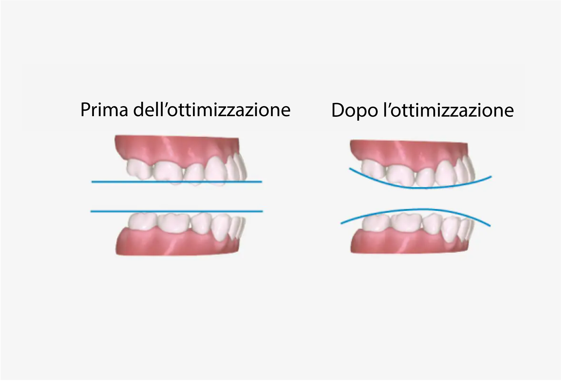 a7-premolar-extraction2_IT