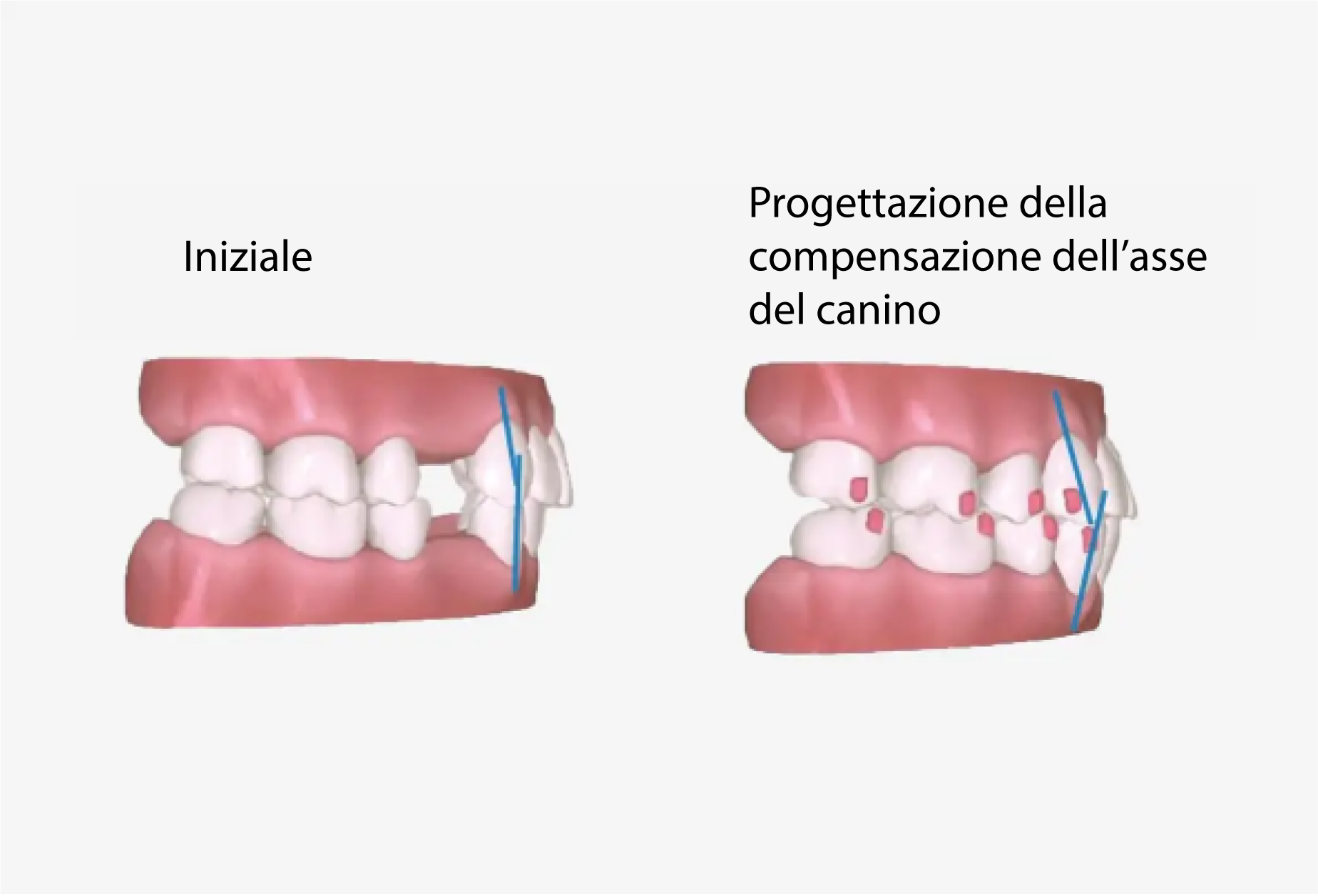 a7-premolar-extraction3_IT