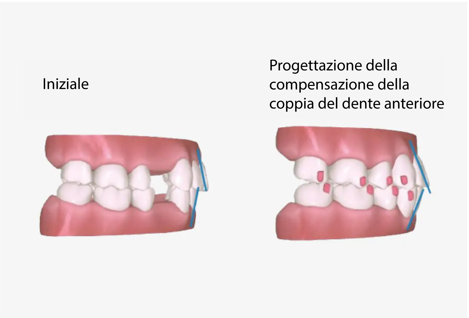 a7-premolar-extraction4_IT