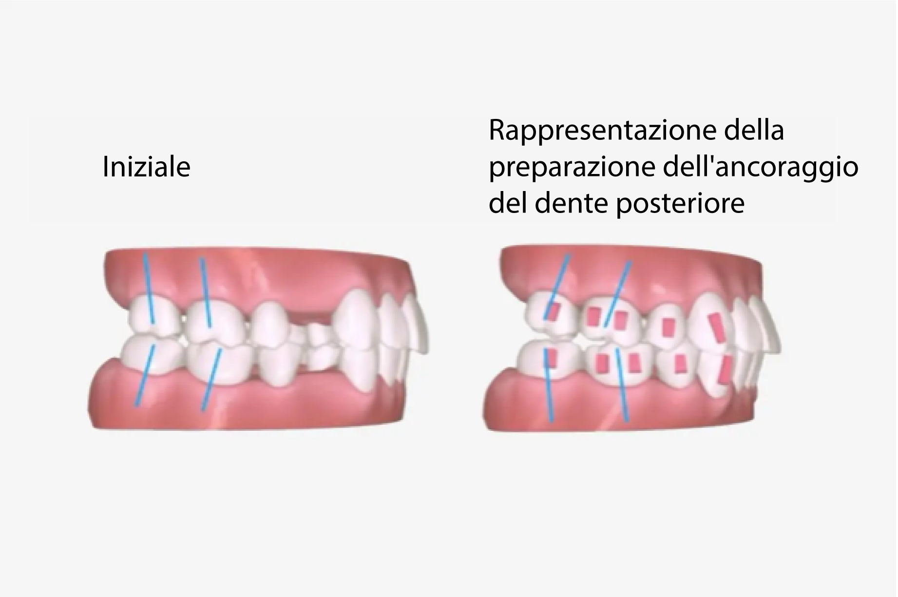 a7-premolar-extraction_IT