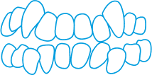 Illustration of two rows of misaligned teeth with spacing and overlapping, outlined in blue, depicting dental crowding or malocclusion.