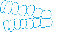 A simple illustration of upper and lower teeth, with one upper tooth outlined in black to indicate a missing or problematic tooth.